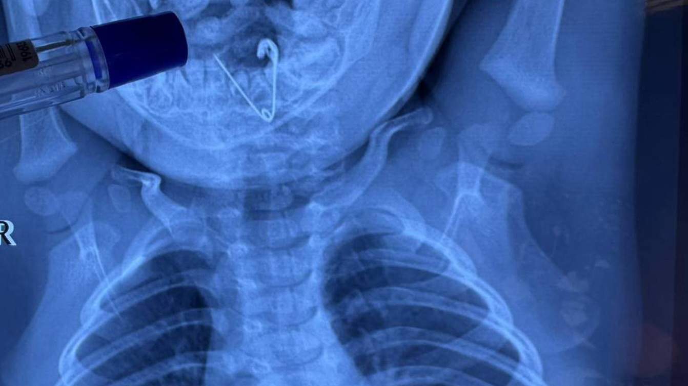 В Черниговском округе младенец проглотил открытую булавку и чудом выжил